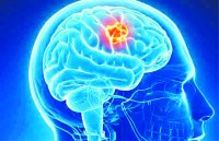 Special on World Brain Tumor-Day