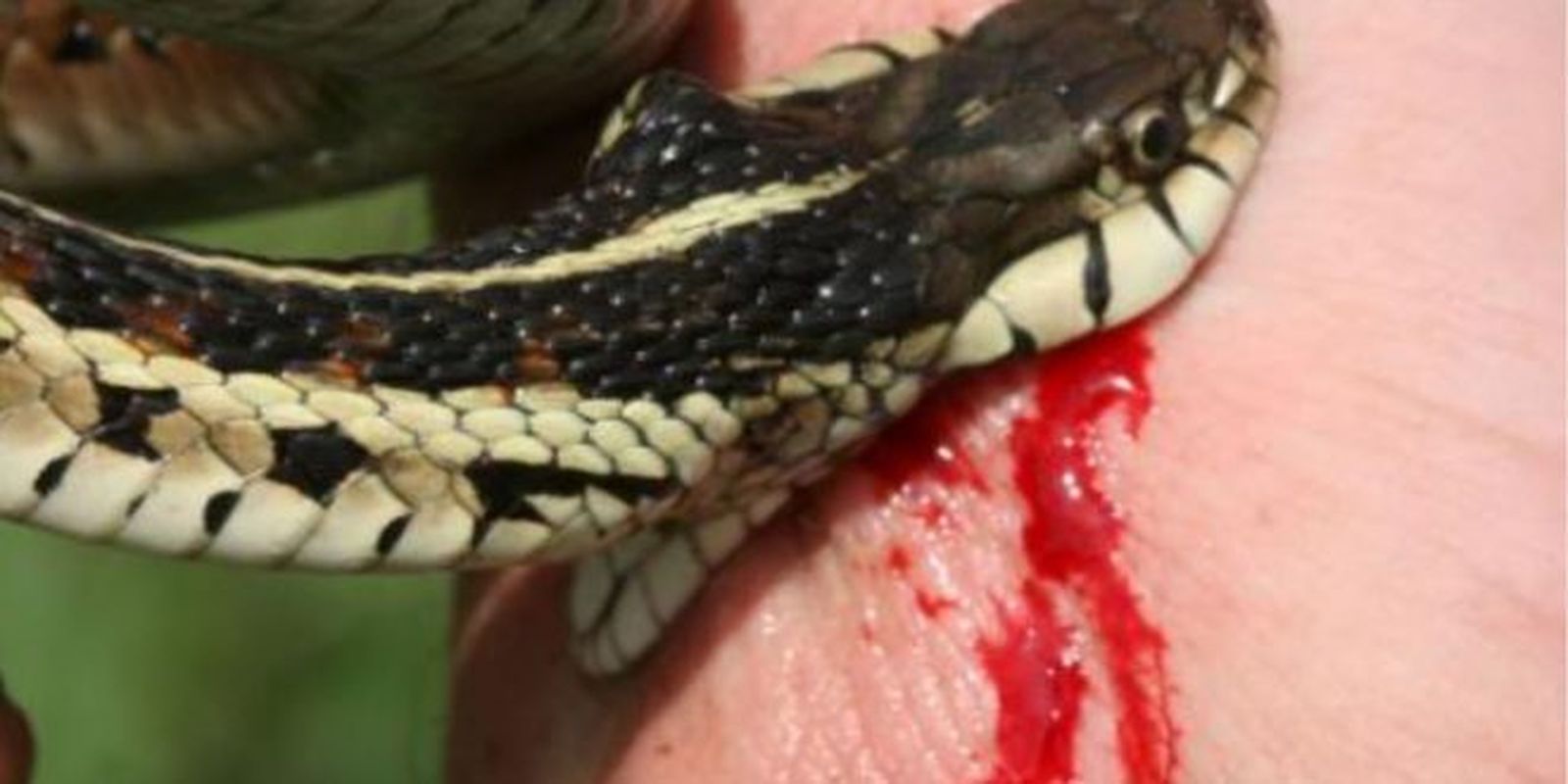 snake bites