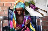 saida ahmed baghili recovered from severe malnutrition in yemen