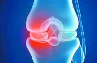 रूमेटाइड आर्थराइटिस