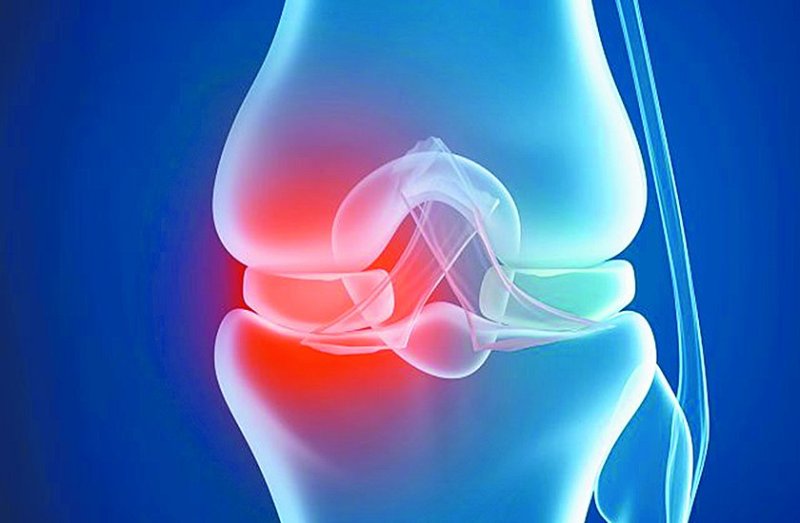 रूमेटाइड आर्थराइटिस