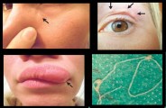 doctors remove live worm crawling under a womans face