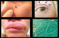 doctors remove live worm crawling under a womans face