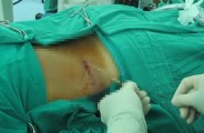 stone surgery