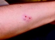 Snake bite mark