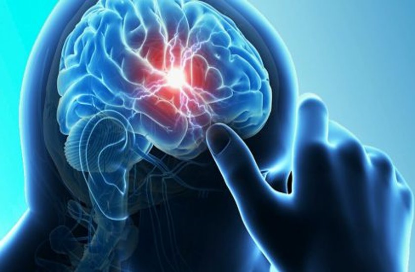Brain stroke