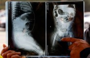 Family shocked after 10 needles found in infants body