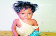vidisha, vidisha news, vidisha patrika, patrika news, patrika bhopal, bhopal mp, Malnutrition, children, Malnutrition kids, nrgs, treatment, problems, 