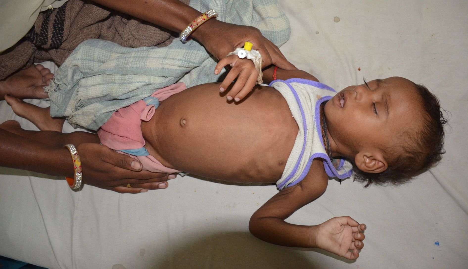 Malnutrition damaged the child's health in khandwa