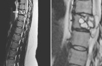 doctor finds out woman has dog tapeworm lodged in her spine