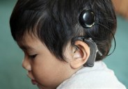 cochlear implant