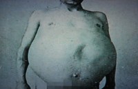 guy who did not poop for 13 long years see what happened to him