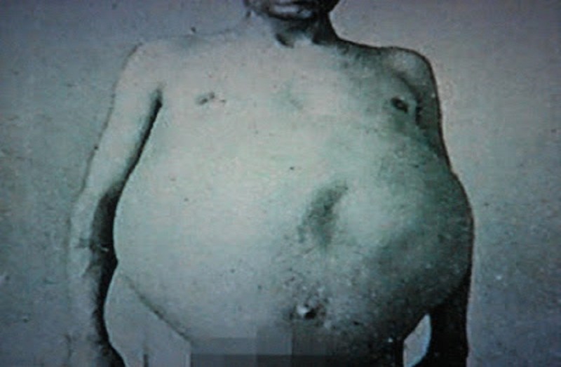 guy who did not poop for 13 long years see what happened to him