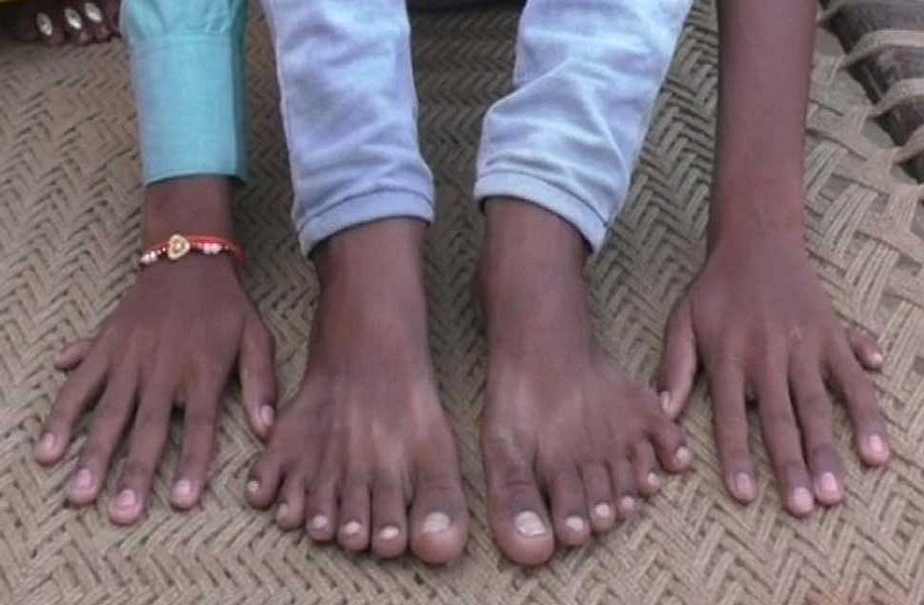 family claims boy with 12 fingers 12 toes faces threat to life