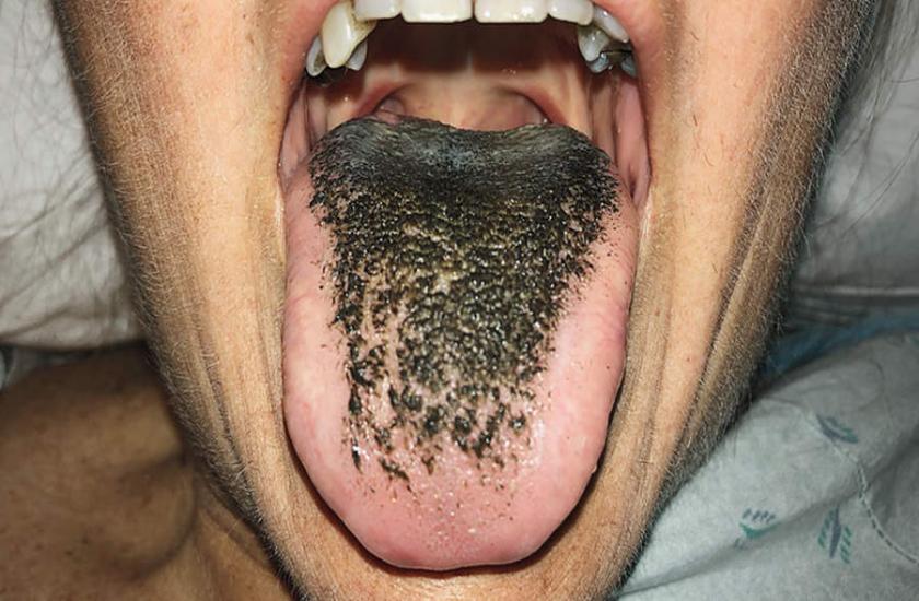 Black hairy tongue
