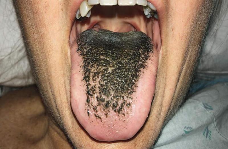 Black hairy tongue