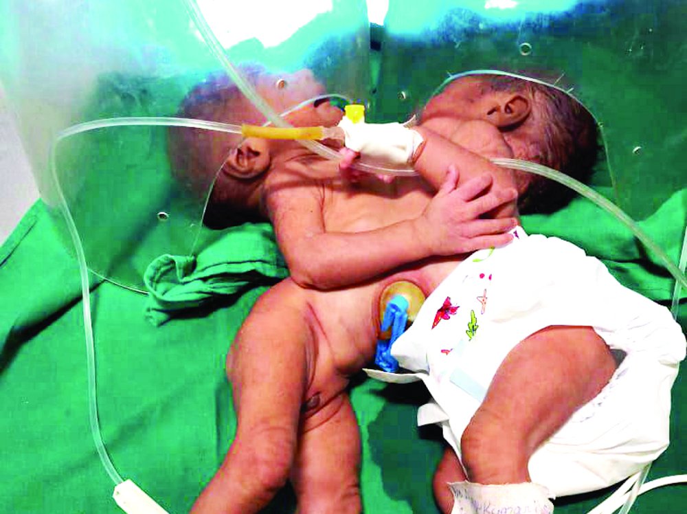Birth of Twin Daughters in satna district hospital
