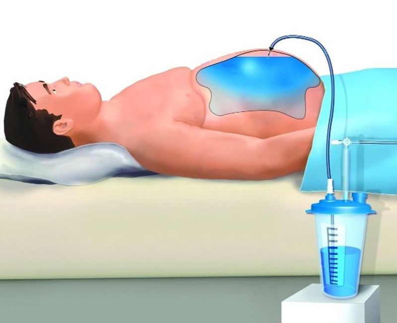 portal hypertension, liver disease