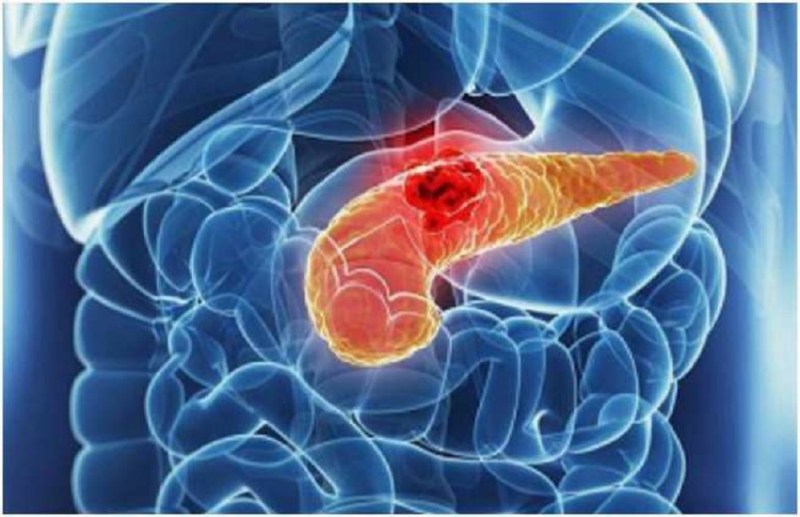 पेट का कैंसर