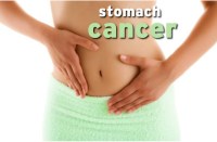 stomach cancer