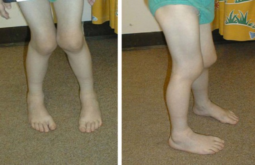 home remedies of arthritis in children