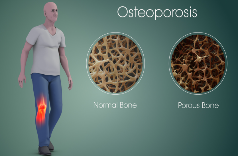 world-osteoporosis-day-expert-advice-for-osteoporosis