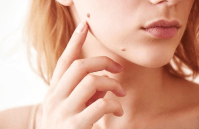 warts