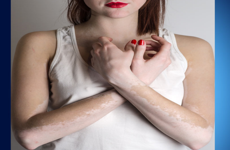 white-skin-stains-are-not-leprosy