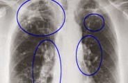 Silicosis