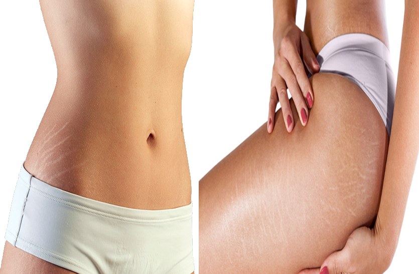 after-pregnancy-remove-such-stretch-marks