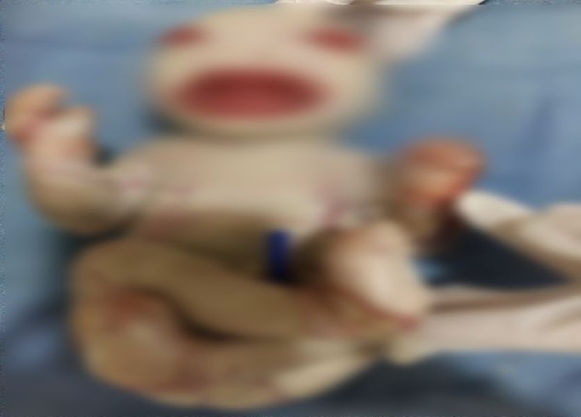 Very Rare Collodion Baby Born In Alwar Rajasthan