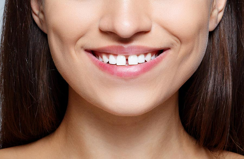know-these-things-if-the-teeth-are-in-the-gap