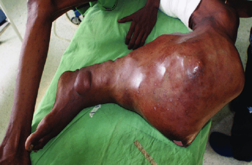 doctors of sir gangaram hospital removed the largest tumor on leg