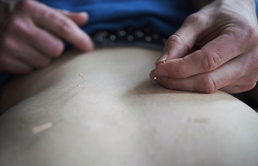 Acupuncture