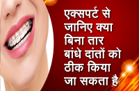 can-the-teeth-be-cured-without-wire-in-teeth