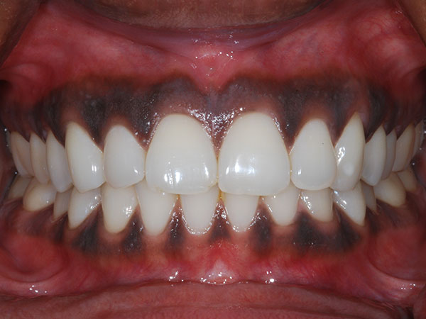loose teeth