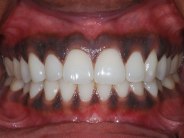 loose teeth