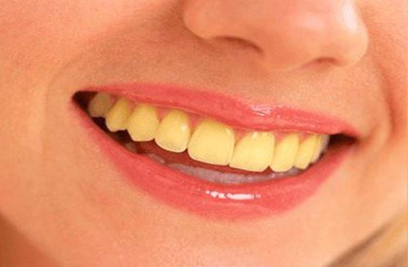these-remedies-help-to-remove-the-yellowing-of-teeth