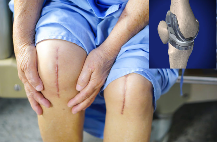 if-you-have-knee-implants-keep-these-things-in-mind