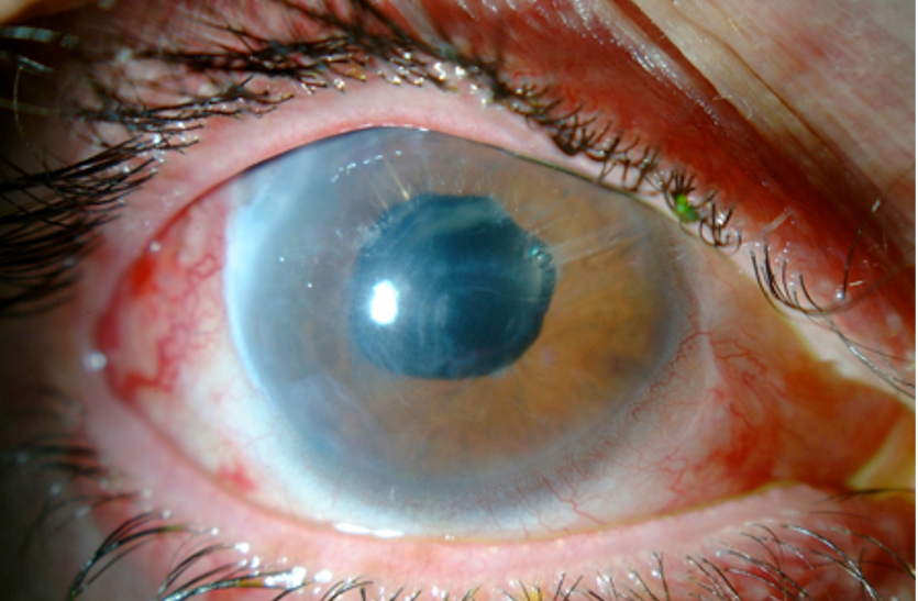 preventing-blindness-with-regular-screening-and-treatment