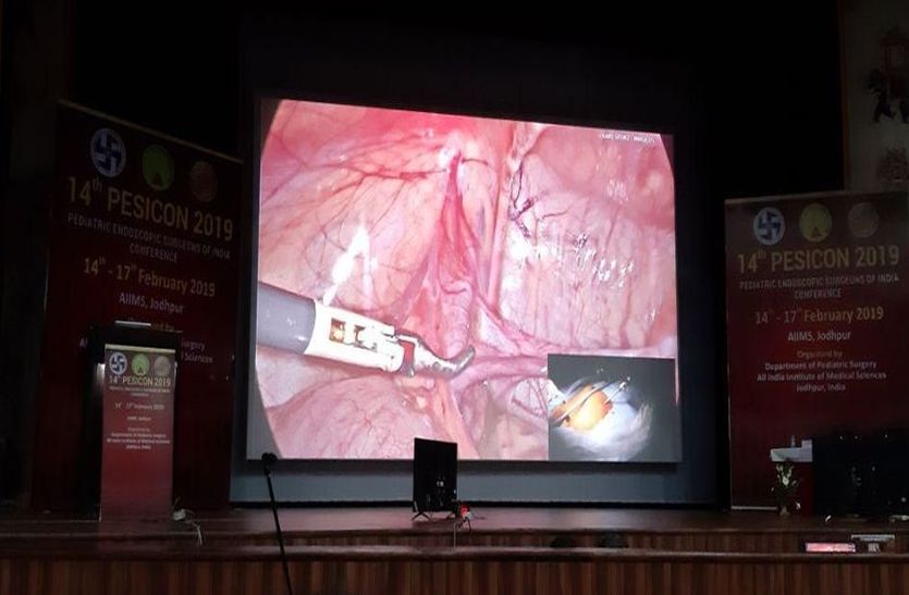 एम्स में कैसे होती हैं Laparoscopic Surgery , देखें बच्चों की लाइव सर्जरी का वीडियो