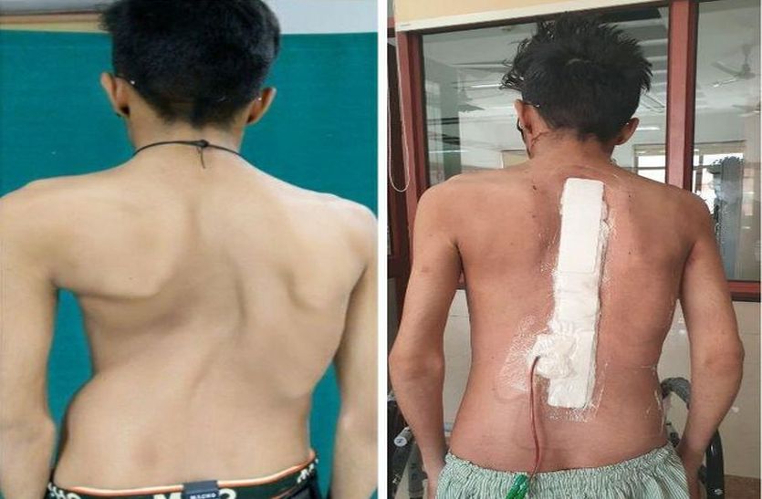 Complex spine surgery in AIIMS, straightened spinal cord