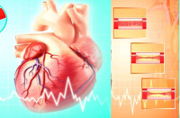 learn-about-angioplasty