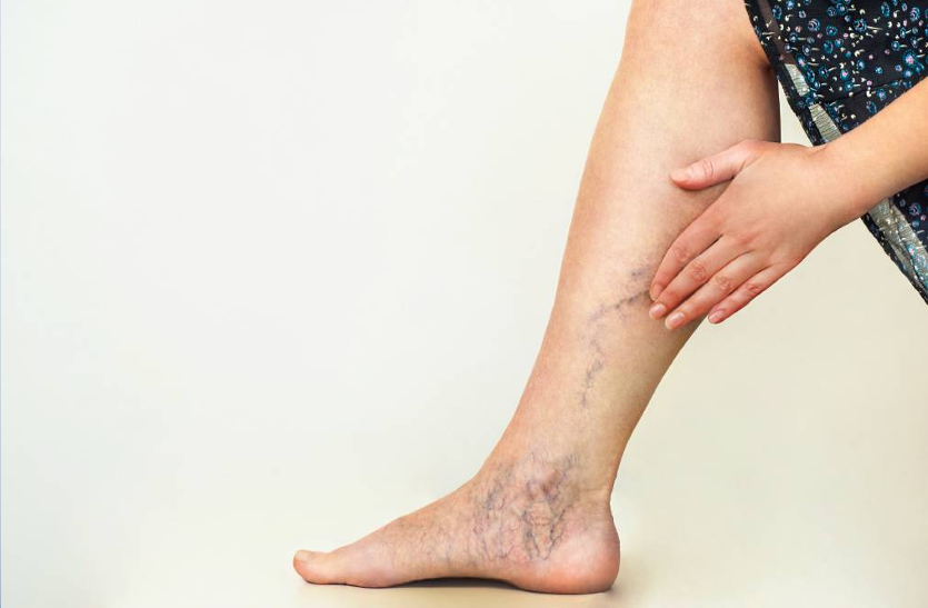 learn-about-varicose-veins