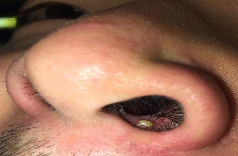 pimple in the nose