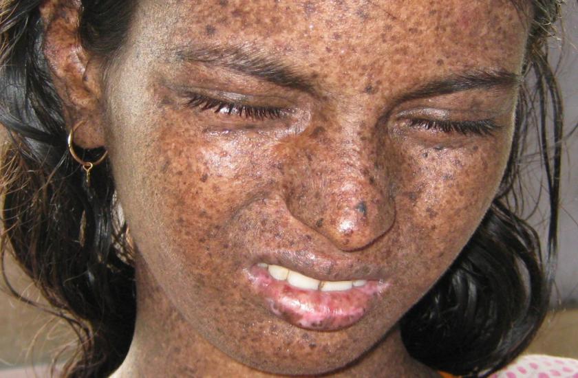 rare skin disease 