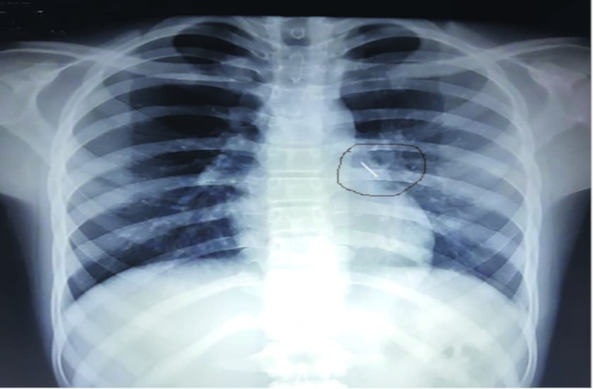 Lungs