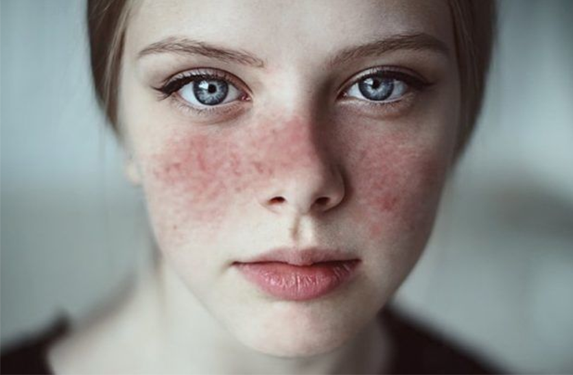 learn-about-systemic-lupus-erythematosus-sle-symptoms