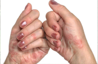Psoriasis
