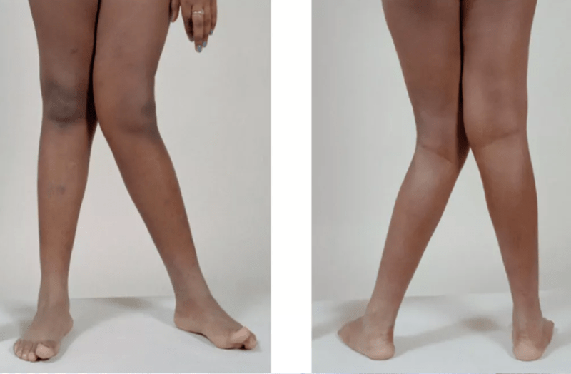 know-about-the-problem-of-having-small-legs-in-children